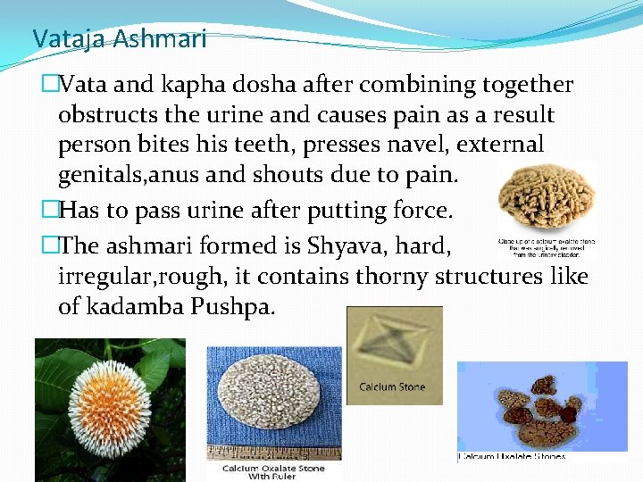 Vataja Ashmari �Vata and kapha dosha after combining together obstructs the urine and causes