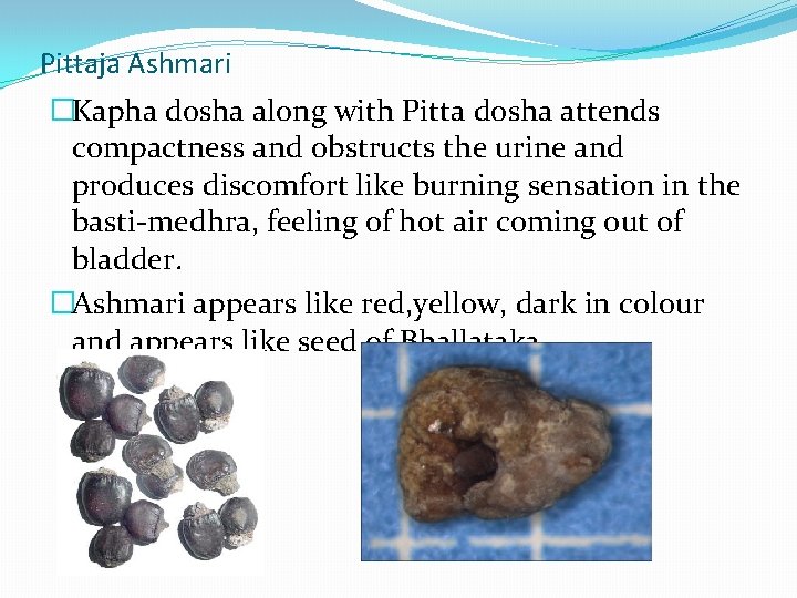 Pittaja Ashmari �Kapha dosha along with Pitta dosha attends compactness and obstructs the urine