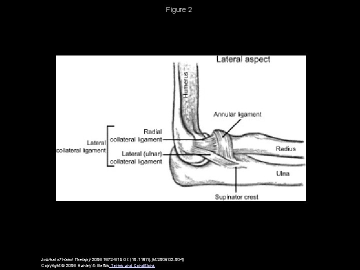 Figure 2 Journal of Hand Therapy 2006 1972 -81 DOI: (10. 1197/j. jht. 2006.