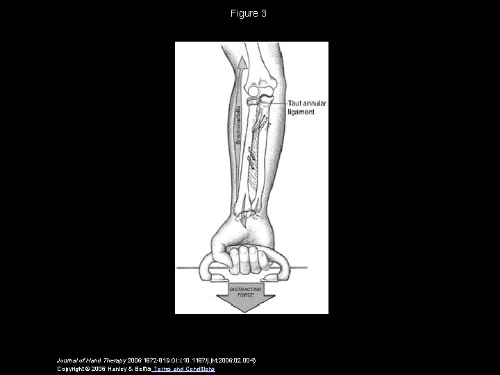 Figure 3 Journal of Hand Therapy 2006 1972 -81 DOI: (10. 1197/j. jht. 2006.