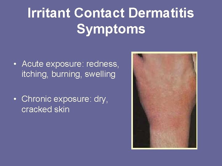 Irritant Contact Dermatitis Symptoms • Acute exposure: redness, itching, burning, swelling • Chronic exposure: