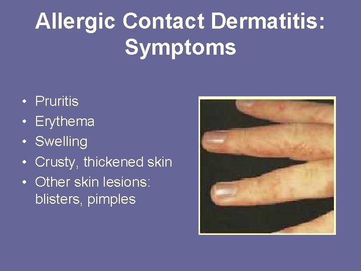 Allergic Contact Dermatitis: Symptoms • • • Pruritis Erythema Swelling Crusty, thickened skin Other