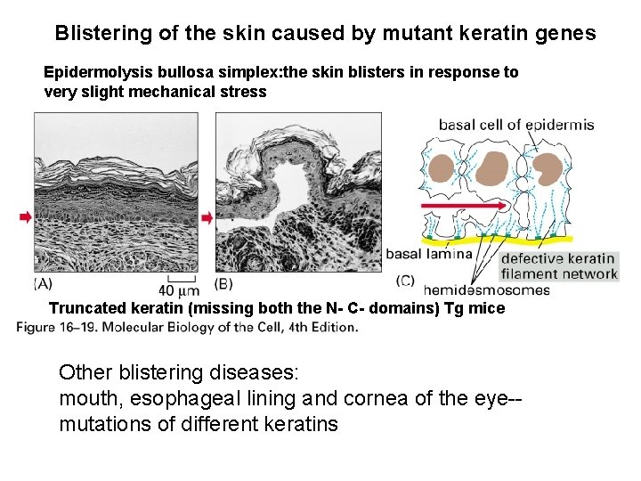 Blistering of the skin caused by mutant keratin genes Epidermolysis bullosa simplex: the skin