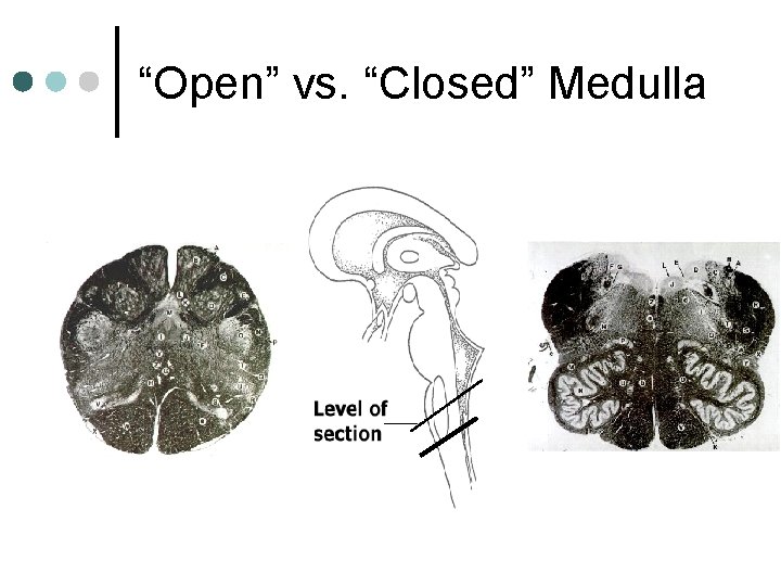 “Open” vs. “Closed” Medulla “Open” vs. “Closed” Medulla