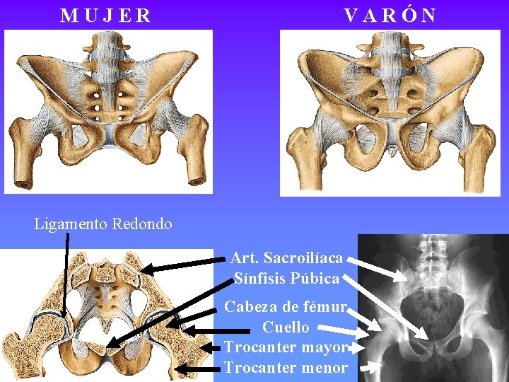 MUJER VARÓN Ligamento Redondo Art. Sacroilíaca Sínfisis Púbica Cabeza de fémur Cuello Trocanter mayor