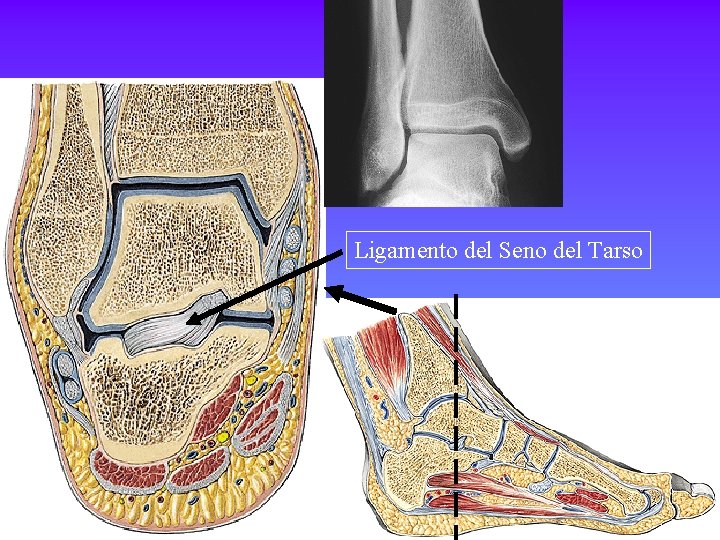 Ligamento del Seno del Tarso 
