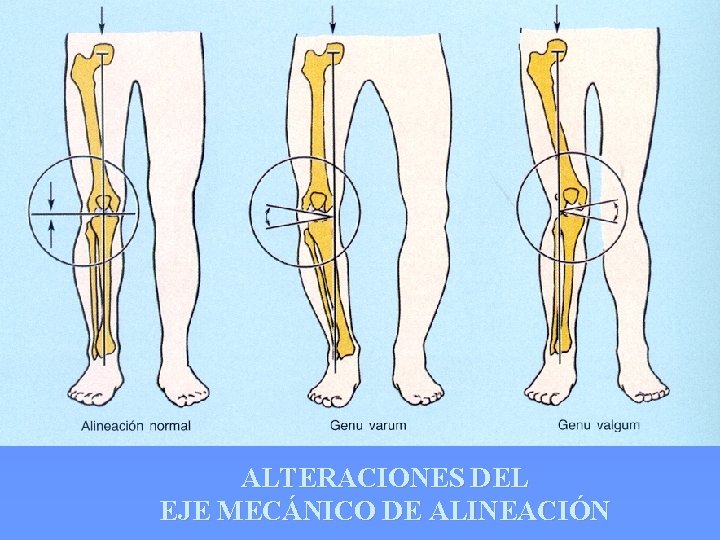 ALTERACIONES DEL EJE MECÁNICO DE ALINEACIÓN 