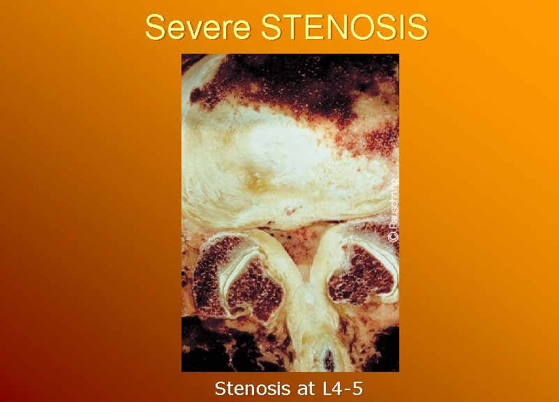 Severe STENOSIS Stenosis at L 4 -5 