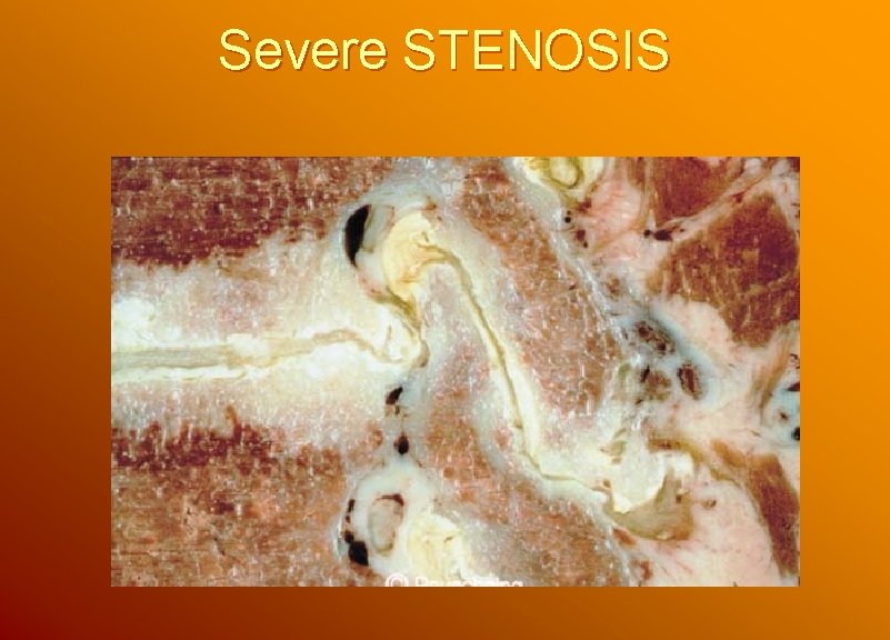 Severe STENOSIS 