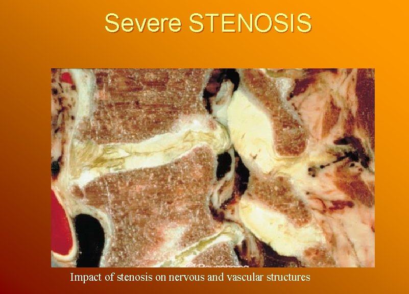 Severe STENOSIS Impact of stenosis on nervous and vascular structures 