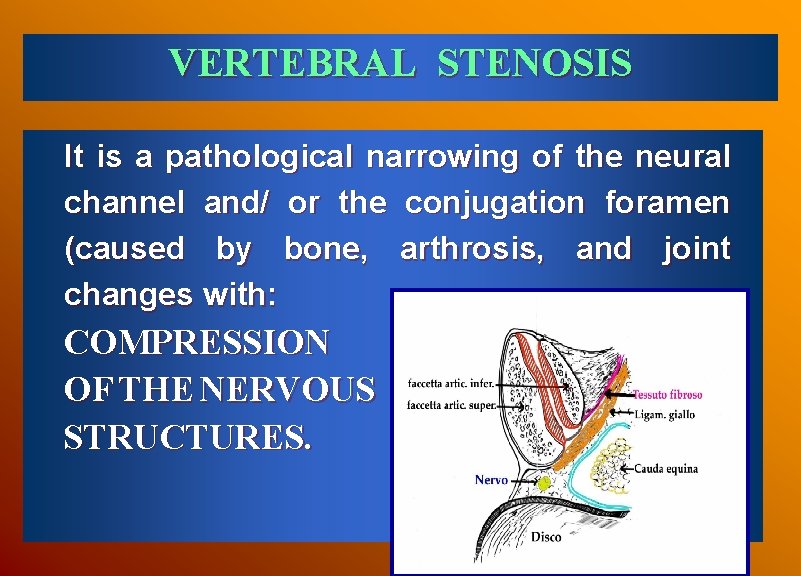 VERTEBRAL STENOSIS It is a pathological narrowing of the neural channel and/ or the