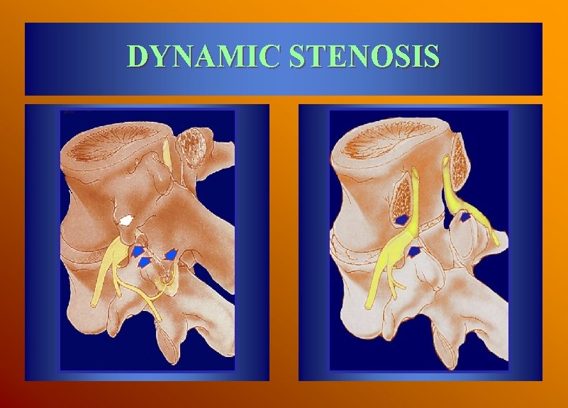 DYNAMIC STENOSIS 