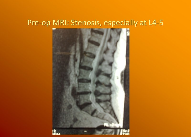Pre-op MRI: Stenosis, especially at L 4 -5 