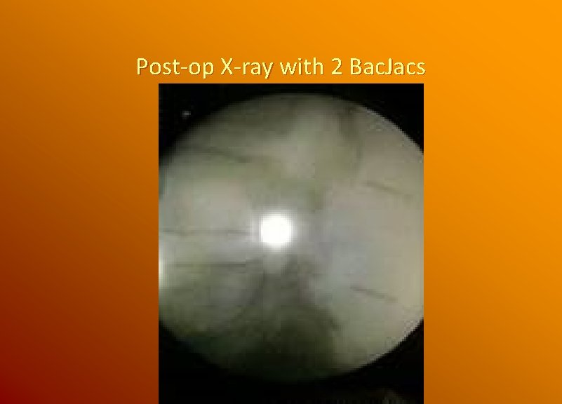 Post-op X-ray with 2 Bac. Jacs 