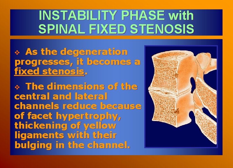 INSTABILITY PHASE with SPINAL FIXED STENOSIS As the degeneration progresses, it becomes a fixed