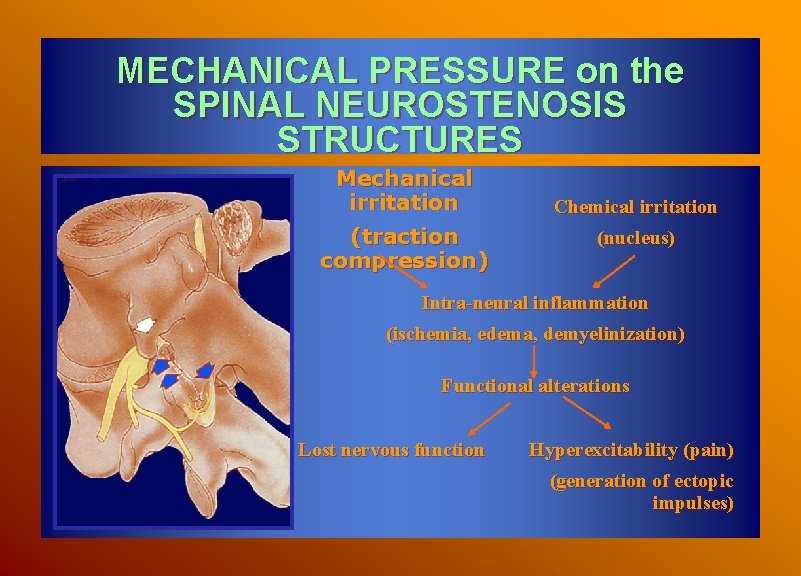 MECHANICAL PRESSURE on the SPINAL NEUROSTENOSIS STRUCTURES Mechanical irritation (traction compression) Chemical irritation (nucleus)