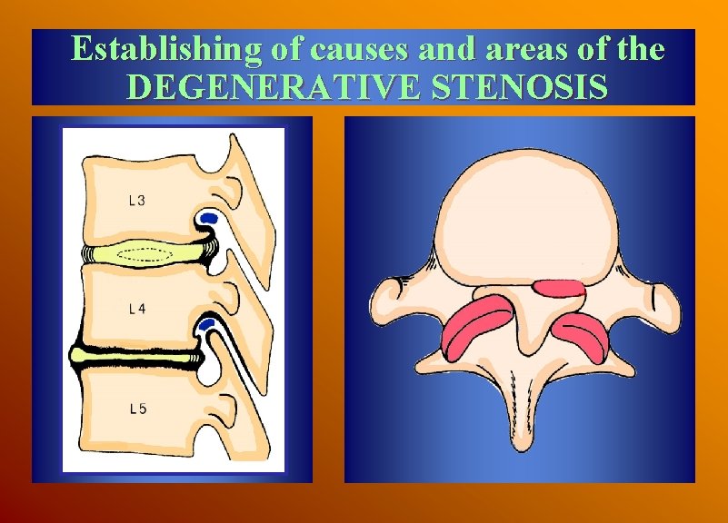 Establishing of causes and areas of the DEGENERATIVE STENOSIS 