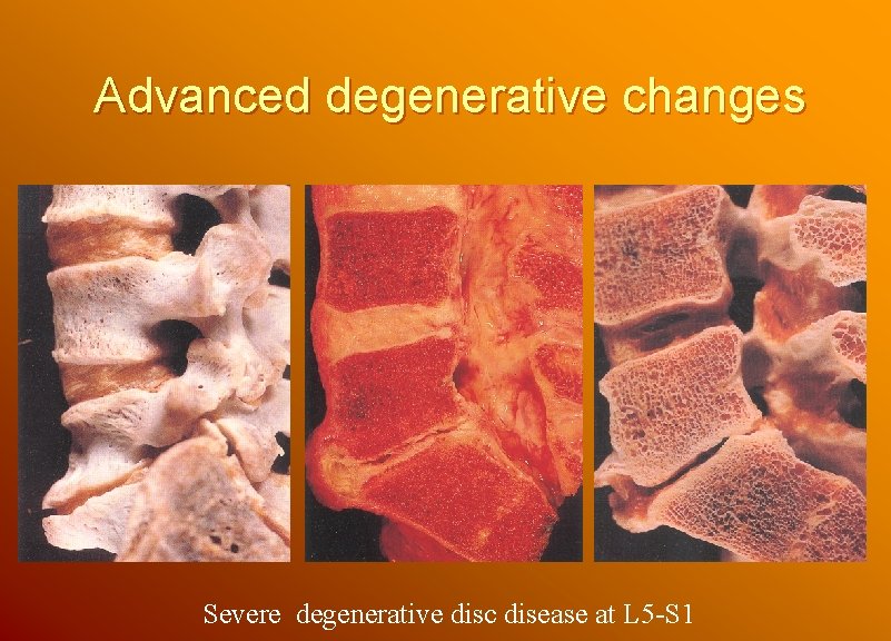 Advanced degenerative changes Severe degenerative disc disease at L 5 -S 1 