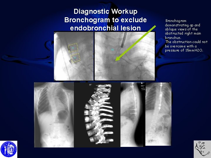 Diagnostic Workup Bronchogram to exclude endobronchial lesion Bronchogram demonstrating ap and oblique views of
