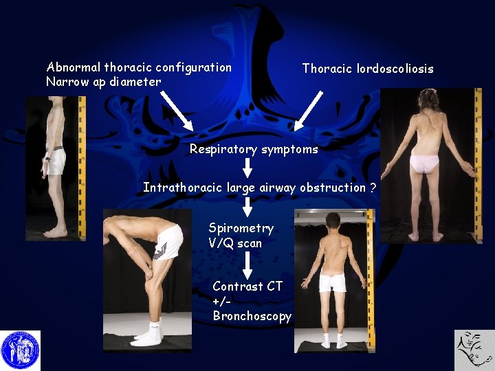 Abnormal thoracic configuration Narrow ap diameter Thoracic lordoscoliosis Respiratory symptoms Intrathoracic large airway obstruction