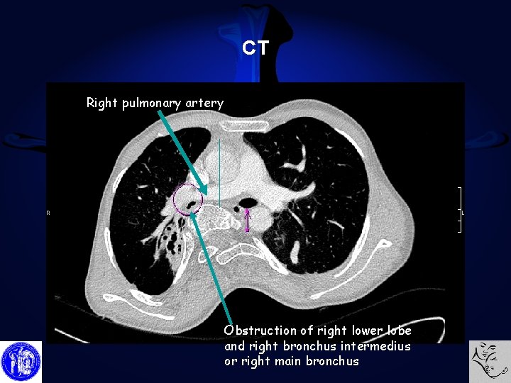 CT Right pulmonary artery Obstruction of right lower lobe and right bronchus intermedius or