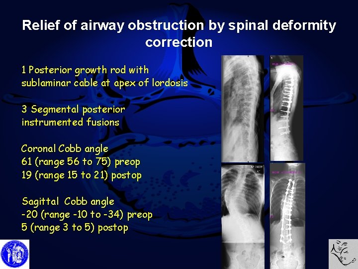 Relief of airway obstruction by spinal deformity correction 1 Posterior growth rod with sublaminar