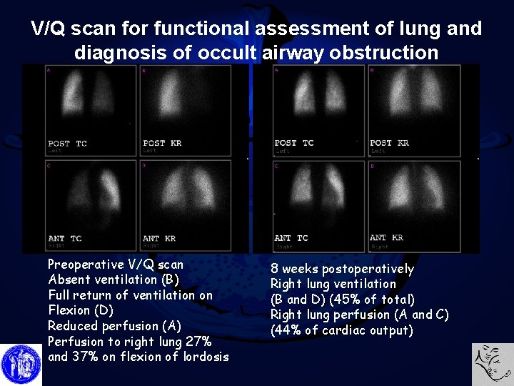 V/Q scan for functional assessment of lung and diagnosis of occult airway obstruction Preoperative