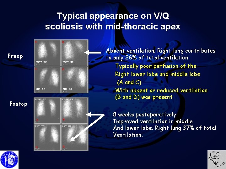 Typical appearance on V/Q scoliosis with mid-thoracic apex Preop Postop Absent ventilation. Right lung