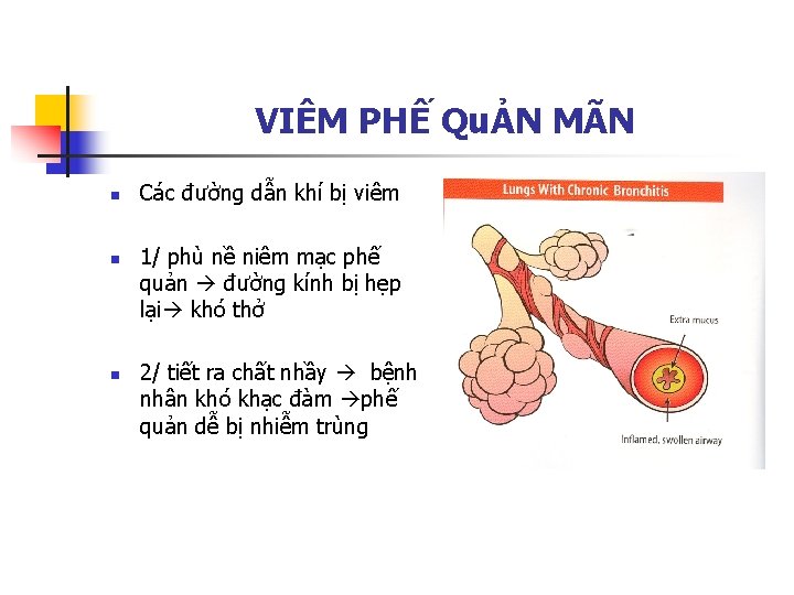 VIÊM PHẾ QuẢN MÃN n n n Các đường dẫn khí bị viêm 1/