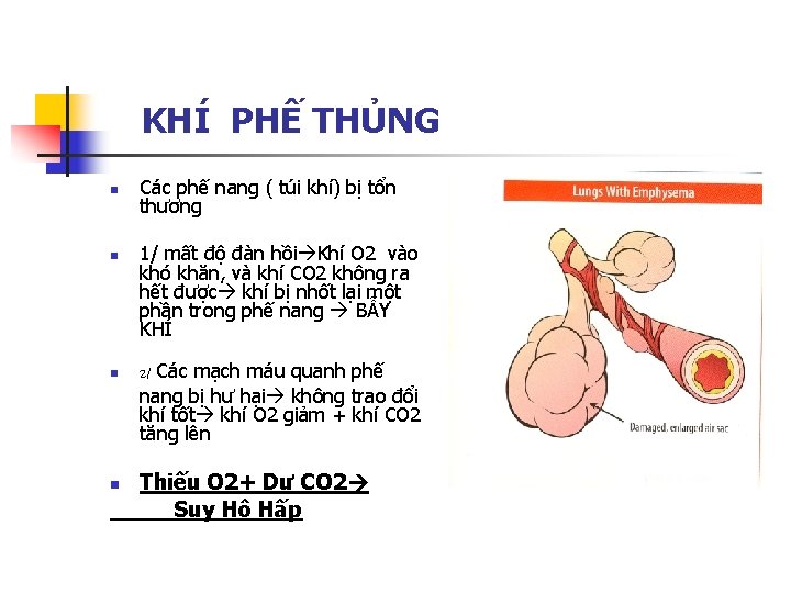 KHÍ PHẾ THỦNG n n Các phế nang ( túi khí) bị tổn thương