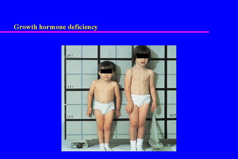 Growth hormone deficiency 