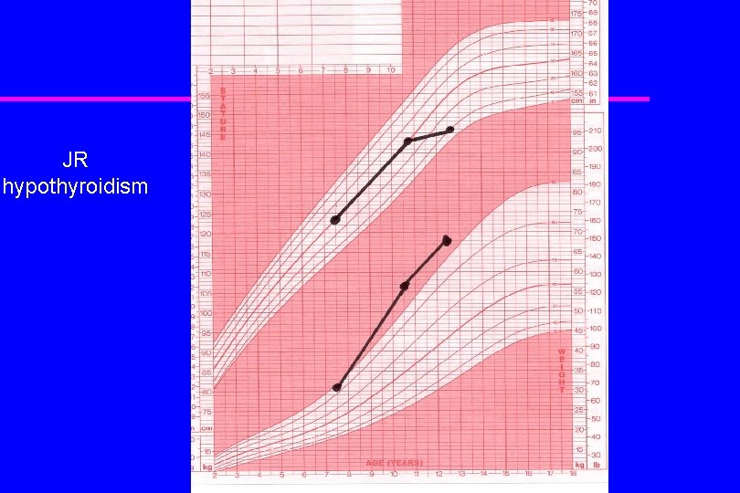 JR hypothyroidism 