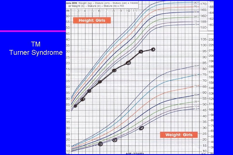 TM Turner Syndrome 