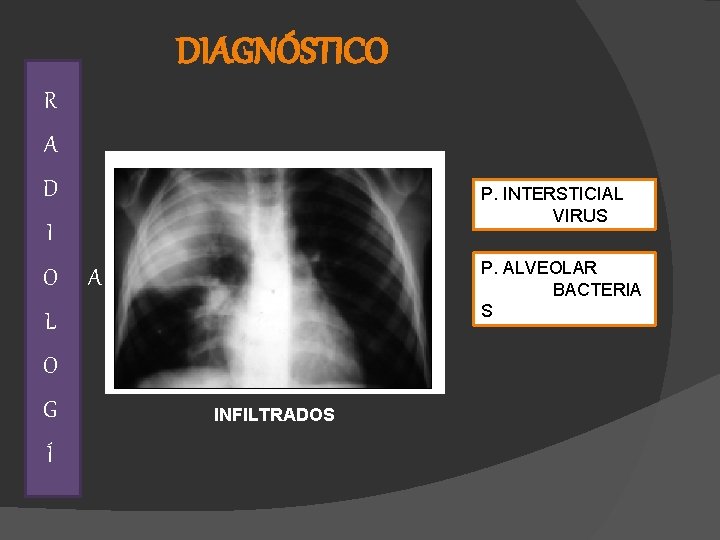 DIAGNÓSTICO R A D P. INTERSTICIAL VIRUS I O P. ALVEOLAR BACTERIA S A