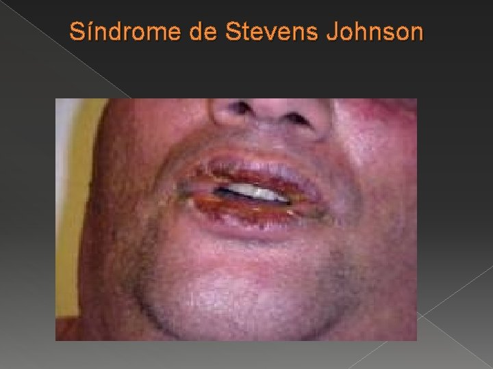 Síndrome de Stevens Johnson 