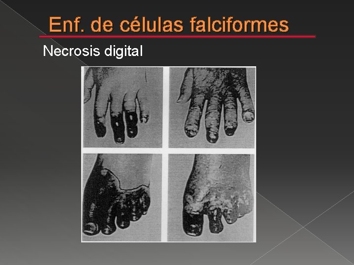 Enf. de células falciformes Necrosis digital 