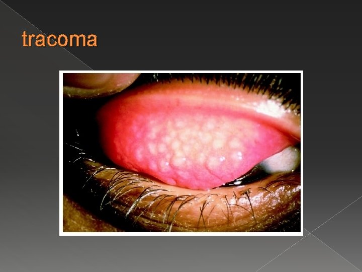 tracoma 