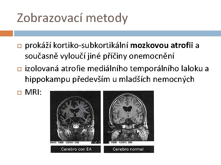Zobrazovací metody prokáží kortiko-subkortikální mozkovou atrofii a současně vyloučí jiné příčiny onemocnění izolovaná atrofie