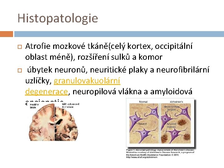 Histopatologie Atrofie mozkové tkáně(celý kortex, occipitální oblast méně), rozšíření sulků a komor úbytek neuronů,