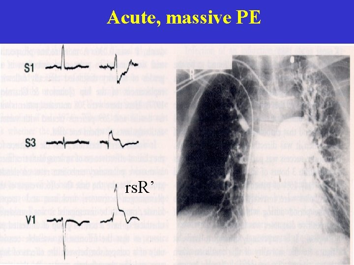 Acute, massive PE rs. R’  Acute, massive PE rs. R’
