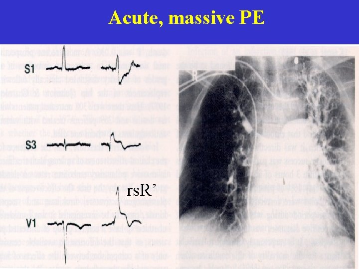 Acute, massive PE rs. R’ 