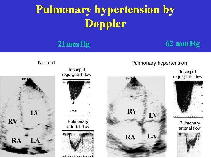 Pulmonary hypertension by Doppler 21 mm. Hg 62 mm. Hg  Pulmonary hypertension by Doppler 21 mm. Hg 62 mm. Hg