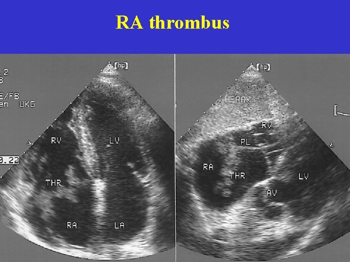 RA thrombus  RA thrombus