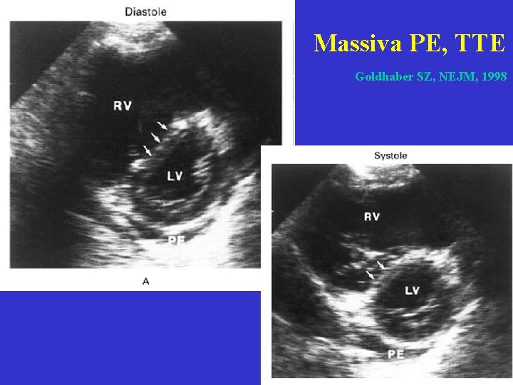 Massiva PE, TTE Goldhaber SZ, NEJM, 1998  Massiva PE, TTE Goldhaber SZ, NEJM, 1998