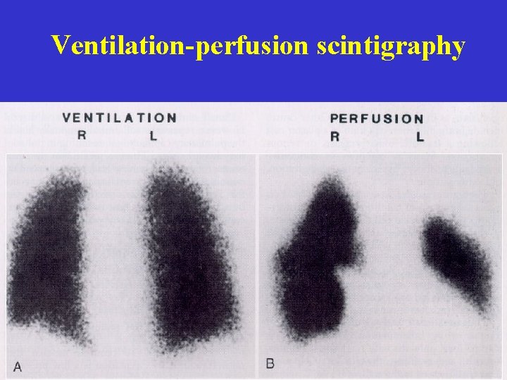 Ventilation-perfusion scintigraphy 
