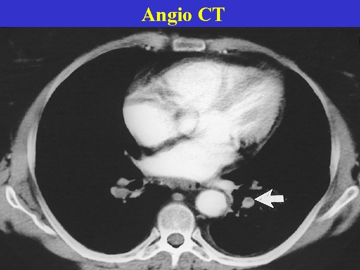 Angio CT  Angio CT