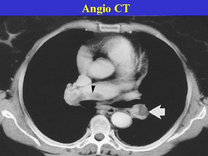 Angio CT  Angio CT