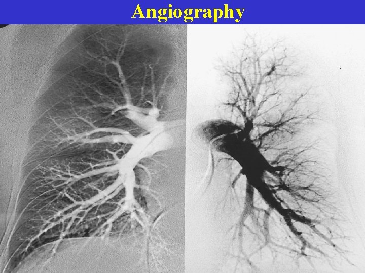 Angiography  Angiography