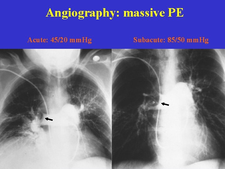 Angiography: massive PE Acute: 45/20 mm. Hg Subacute: 85/50 mm. Hg 