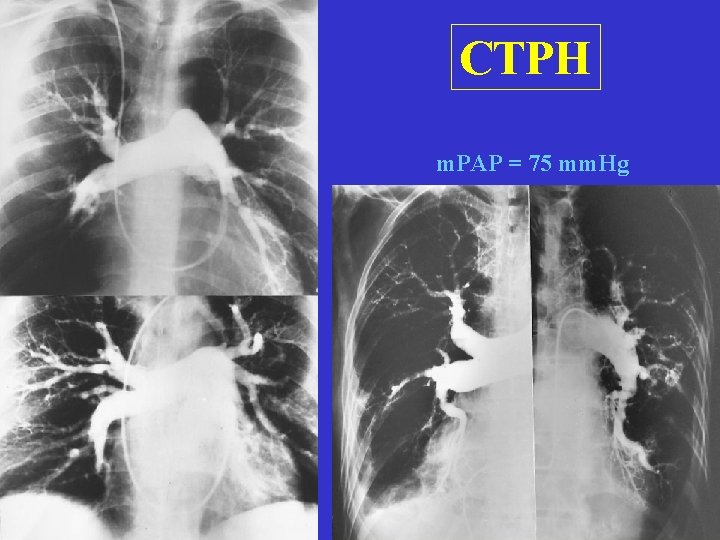 CTPH m. PAP = 75 mm. Hg 